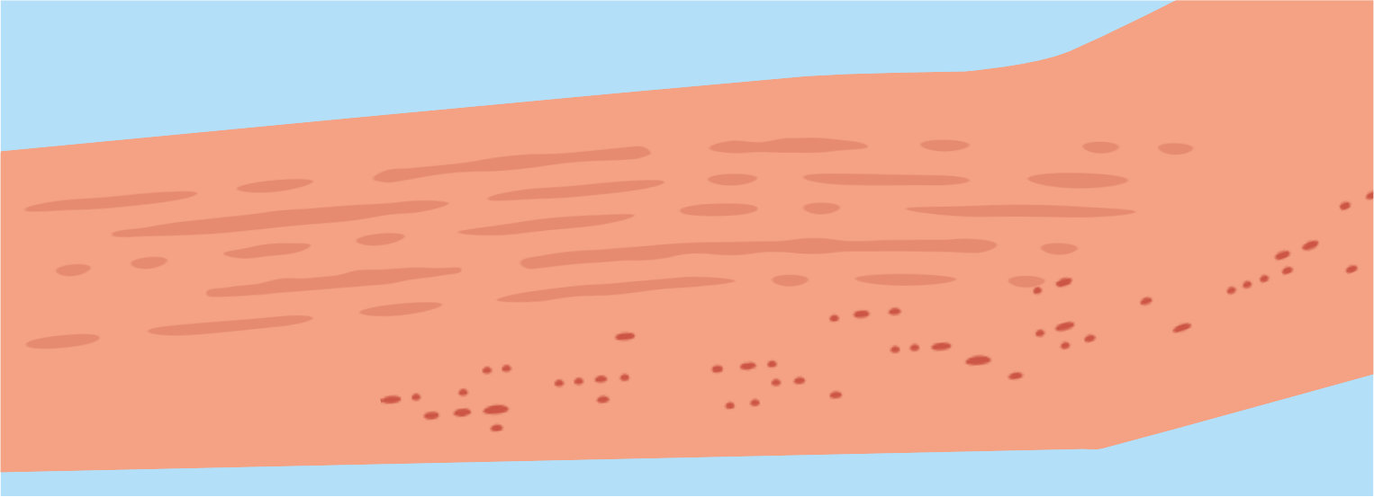 What Causes Eczema? The Hard Facts about Water Advice from AIWSE